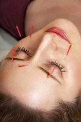 Acupuncture treatment to face